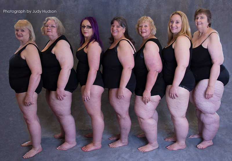 Lipoedema Awareness Lipoedema Awareness
